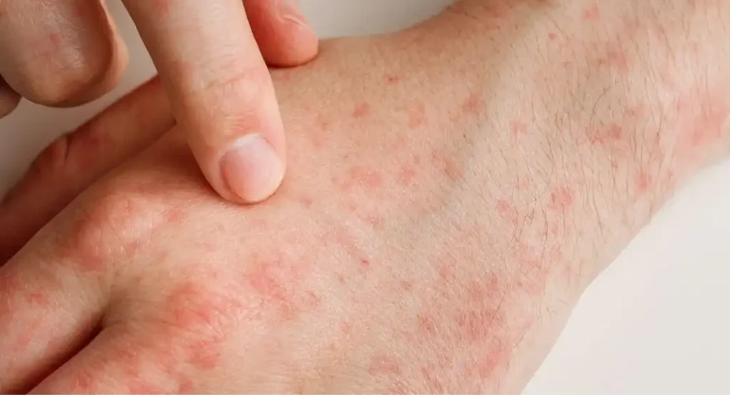 Aumento de Casos de Sarampión en el Estado de México: Un Llamado a la Vacunación