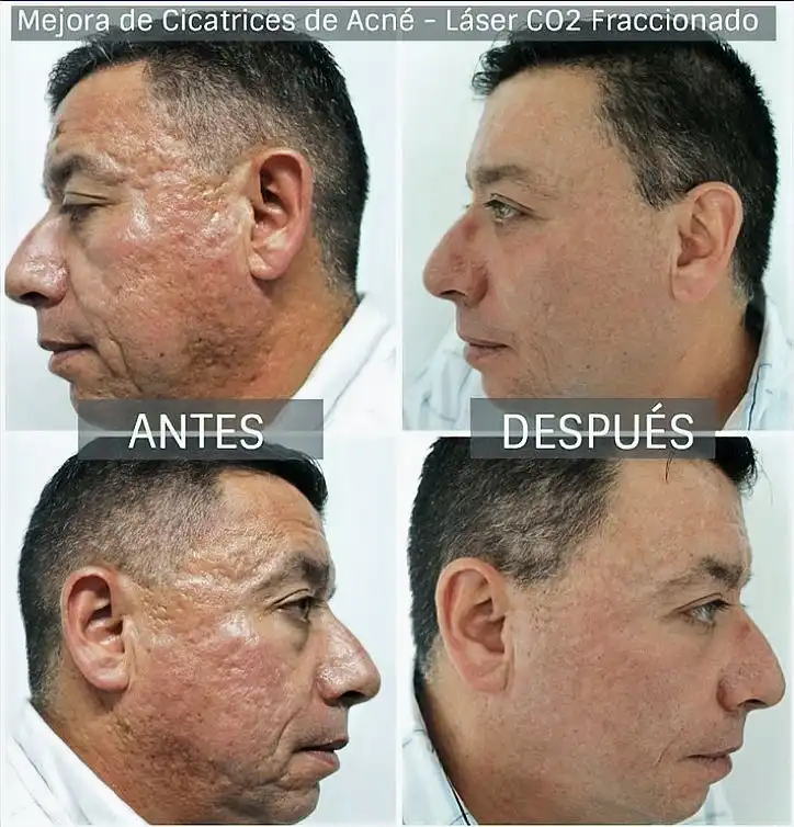 Transformación de la Piel: El Poder del Tratamiento con Láser para Cicatrices