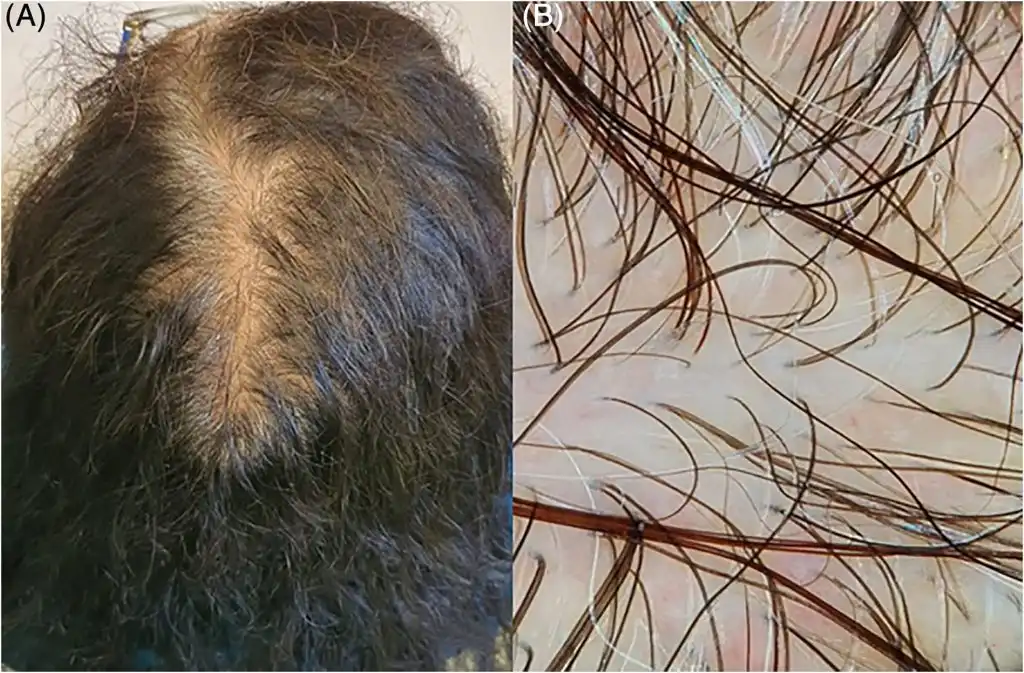 Efluvio Telógeno: Comprendiendo la Caída del Cabello en Mujeres